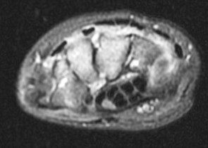 Figure 2 for case Juvenile idiopathic arthritis
